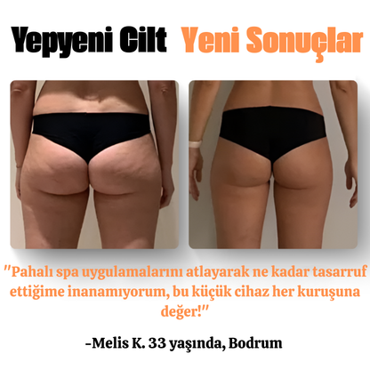 Vpag Selülit Aleti